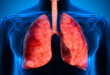 how tuberculosis looks