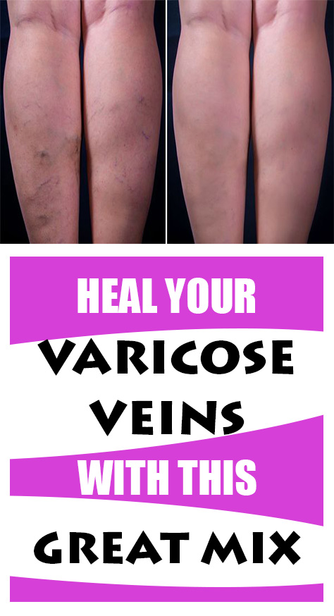 This kind of mix will surely help. You should use apple cider, carrot and aloe vera and treat the varicose veins pain. Unsightly and painful, the varicose veins are often caused by genetics or some certain daily habits and the kind of lifestyle.