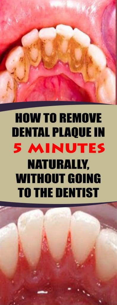 Dental plaque is the buildup of food waste in both the internal and external teeth surfaces. This is an oral problem which can contribute to bad breath and other oral health problems if the residues harden and become calcined in the teeth and cause bleeding.