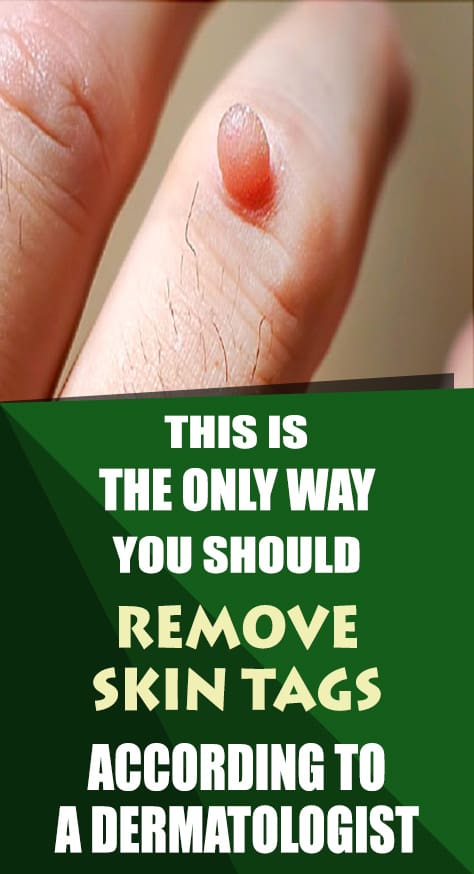 People have been wondering whether it would be a good idea to remove skin tags or not. Well, the answer is no. Most of the time they are actually harmless. However, they can cause irritation. This is why a lot of people decide to remove them. So, if you want to remove them, you need to figure out how you can do it in a safe way.
