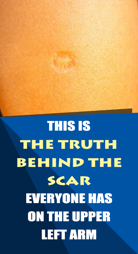 Many people have a small round scar on their left arm and it’s often different in size and shape in different people. But, where did this scar come from?