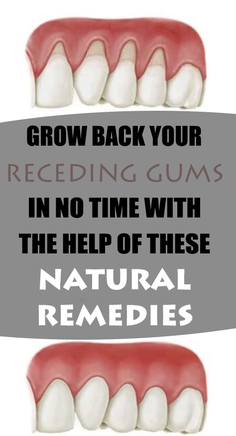 The situation of receding gums happens when the tissue of the gum around the teeth corrodes and it looks like your gums recede backwards. Then a large surface of the teeth is exposed and more visible.