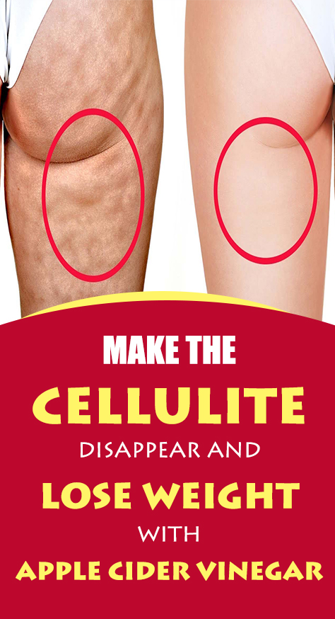 This persistent subcutaneous fat usually appears on thighs, hips, and breasts of women. A skin with cellulite resembles an orange peel or a cottage cheese. Not so attractive, right?