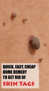 Quick, Easy, Cheap Home Remedy to Get Rid of Skin Tags