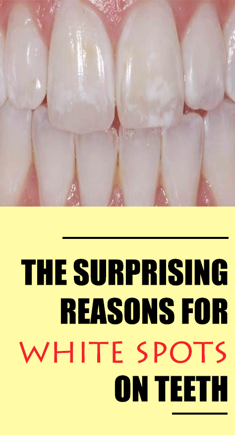 Find out in this article how to make your own homemade toothpaste to remineralize the enamel surface of your teeth. We will also look at easy ways to prevent the appearance of white blotches under the hard, shiny surface of your teeth.