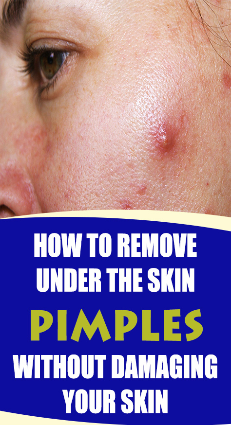 Pimples under the skin are a nuisance. Learn how to bring them to the skin surface and how to efficiently get rid of them.