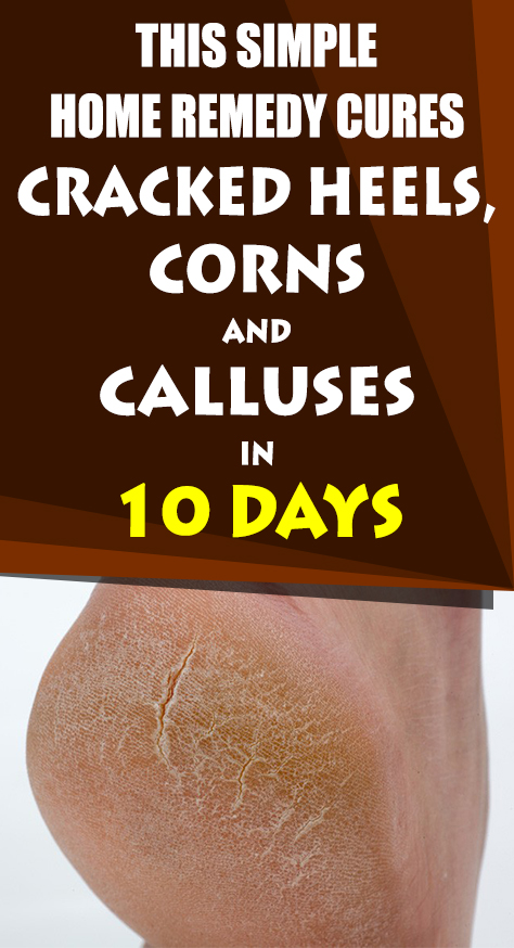This article offers you a simple homemade remedy that will provide beneficial effects and will help you in the fight against cracked heels, calluses and corns.