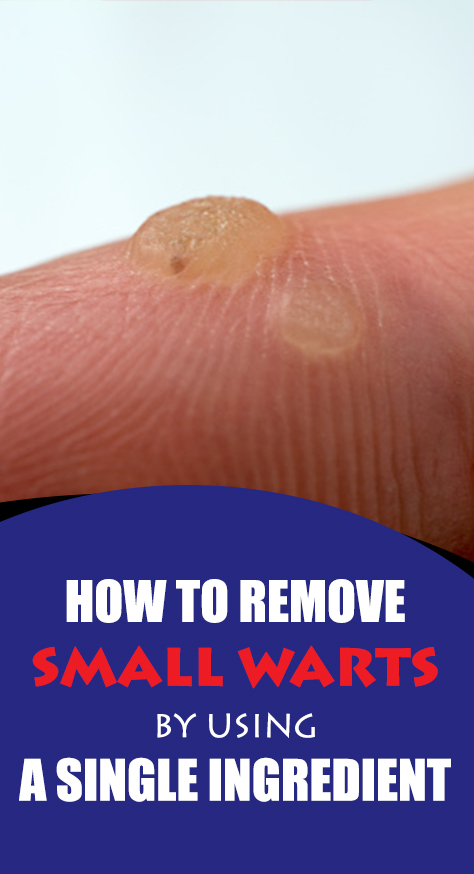 Do not panic if you notice a wart. Just try this one ingredient we are about to present to you and you will be able to get rid of them. What we mean here is apple cider vinegar.