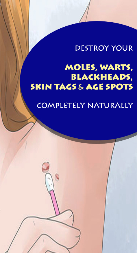 We are here to present you a couple of natural remedies that can help you get rid of blackheads, skin tags, warts, moles, and spots.