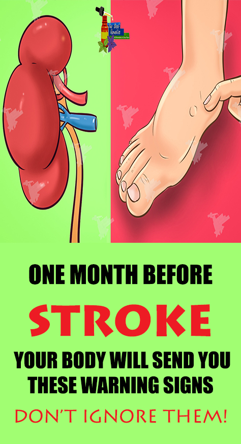 According to the experts, the symptoms of stroke can vary from one person to another and depend on the type of stroke, the severity of the damage and the part of the brain affected. However, all stroke symptoms have one thing in common – they always occur suddenly.