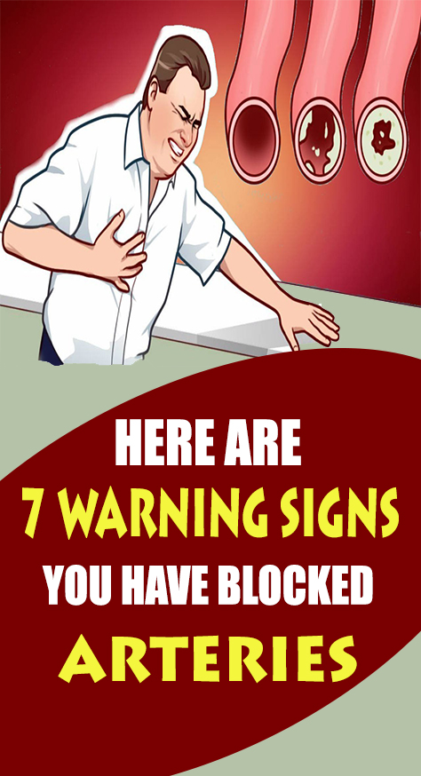 Bad circulation in and of itself is never good, however, it could mean that you have blocked arteries. Having a blocked artery can kill you. This is why it’s important to know the signs so you can catch this in time.