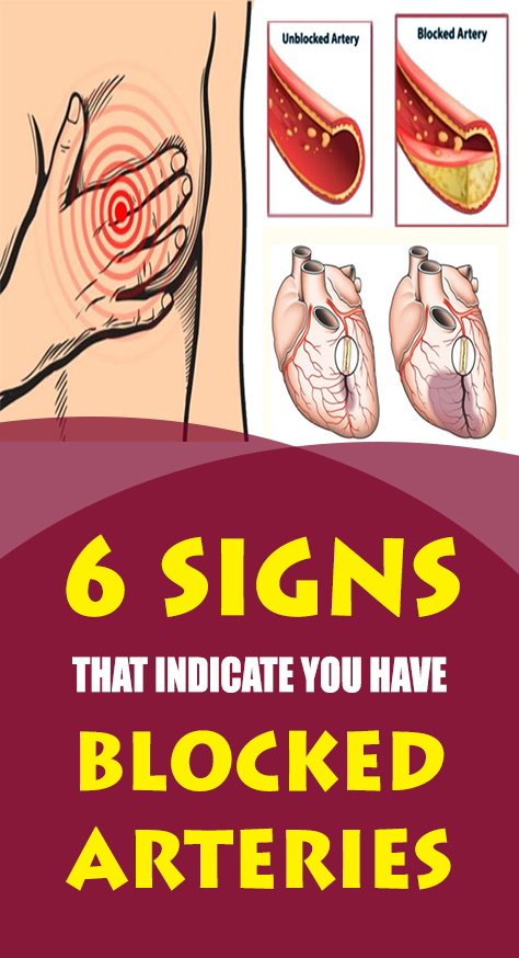 Many people affected by this health problem can’t understand what’s happening until it is too late. That’s why it is very important to know the signs and symptoms of blocked arteries and go to doctor as soon as possible.