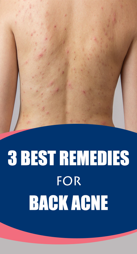Here are some effective home remedies that help get rid of back acne naturally. All you have to do is follow them regularly until you get complete relief from the acne.