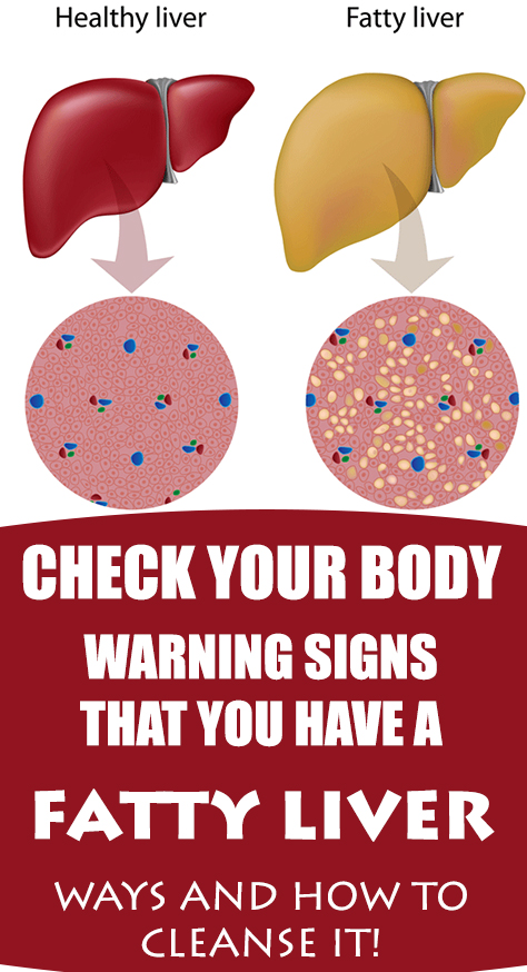 CHECK YOUR BODY: Warning Signs That You Have a Fatty Liver Ways and How ...