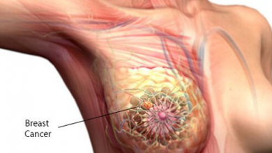 image of a breast cancer